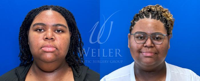 Before & After Liposuction Case 1366 Front View in Baton Rouge, New Orleans, & Lafayette, Louisiana