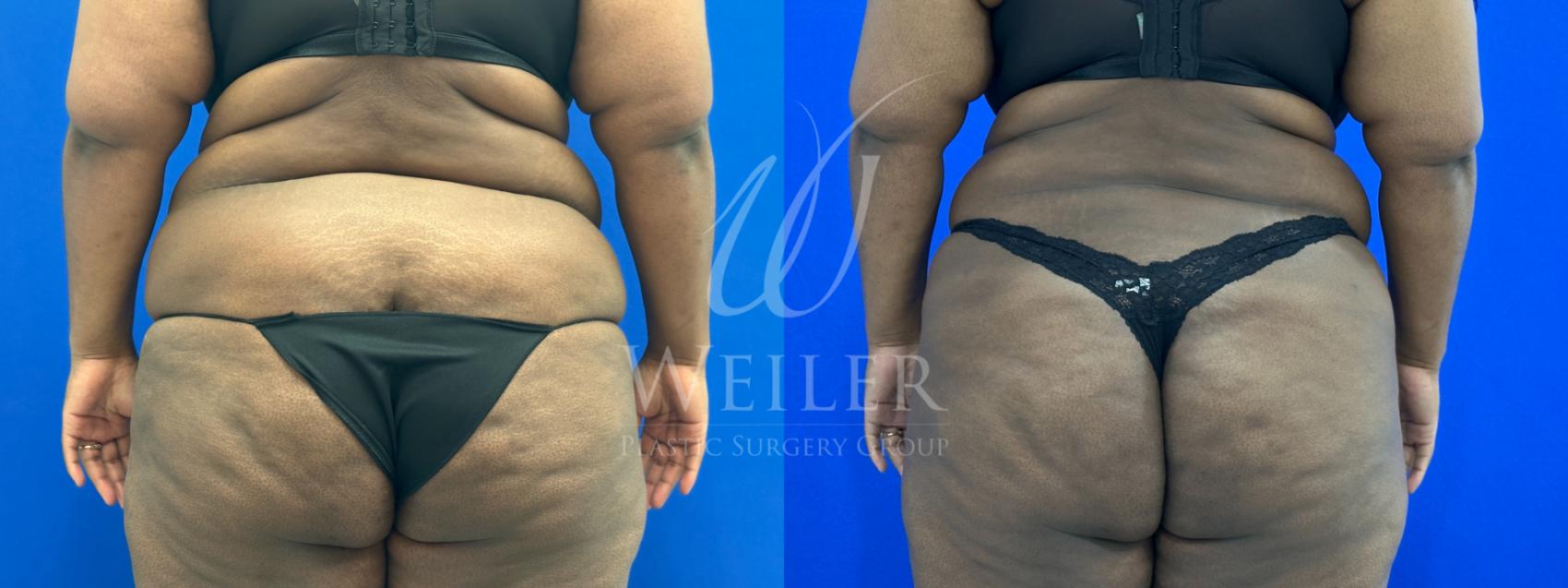 Before & After Liposuction Case 1524 Back View in Baton Rouge, New Orleans, & Lafayette, Louisiana