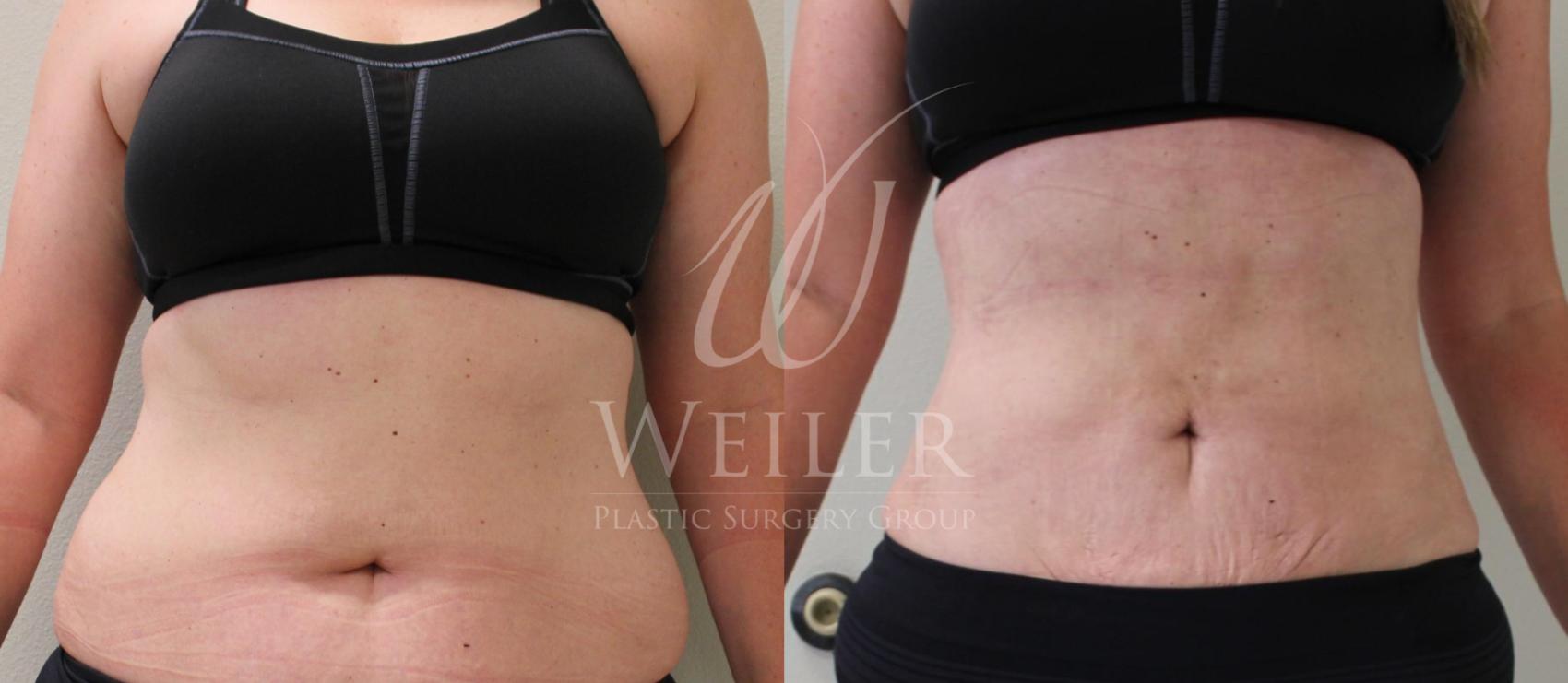 Before & After Liposuction Case 163 View #1 View in Baton Rouge, New Orleans, & Lafayette, Louisiana