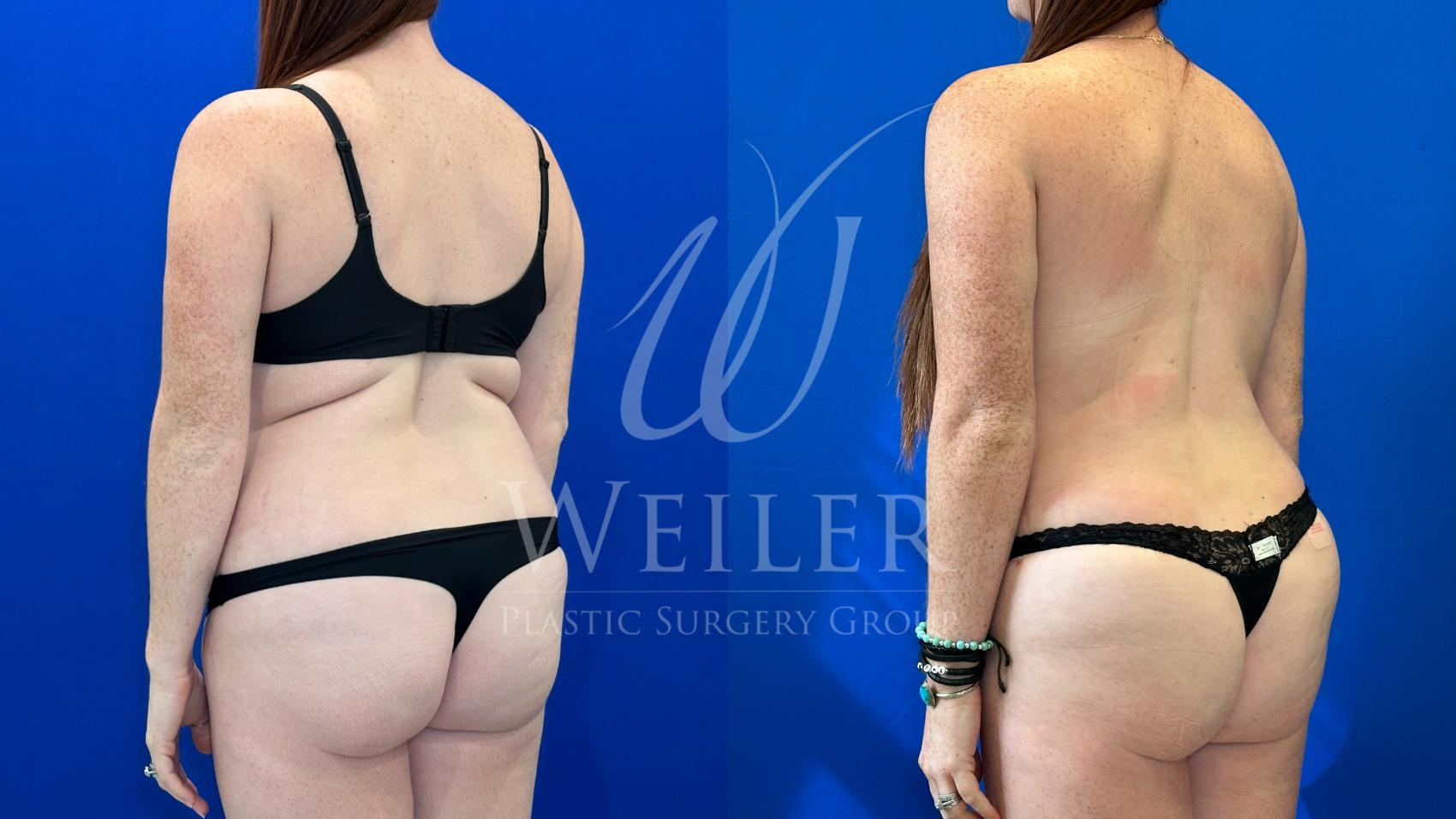 Before & After Liposuction Case 1660 Left Side View in Baton Rouge, New Orleans, & Lafayette, Louisiana