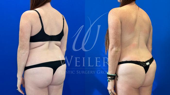 Before & After Liposuction Case 1660 Left Side View in Baton Rouge, New Orleans, & Lafayette, Louisiana