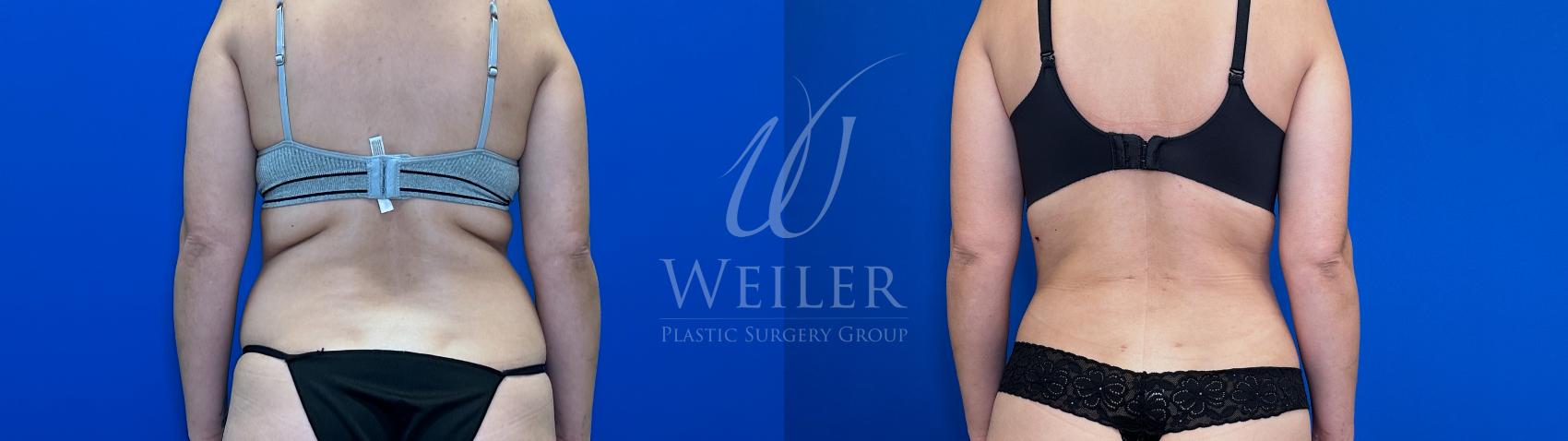 Before & After Liposuction Case 1674 Back View in Baton Rouge, New Orleans, & Lafayette, Louisiana