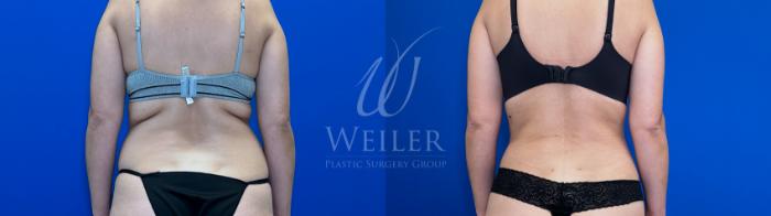 Before & After Liposuction Case 1674 Back View in Baton Rouge, New Orleans, & Lafayette, Louisiana