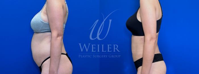 Before & After Liposuction Case 1674 Left Side View in Baton Rouge, New Orleans, & Lafayette, Louisiana