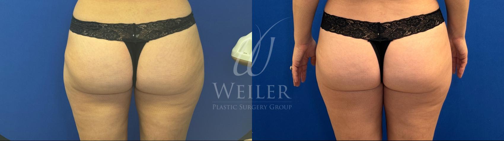Before & After Liposuction Case 1745 Back View in Baton Rouge, New Orleans, & Lafayette, Louisiana
