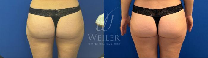 Before & After Liposuction Case 1745 Back View in Baton Rouge, New Orleans, & Lafayette, Louisiana