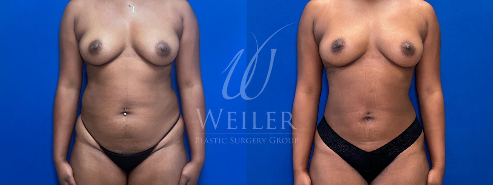 Before & After Liposuction Case 1803 Front View in Baton Rouge, New Orleans, & Lafayette, Louisiana