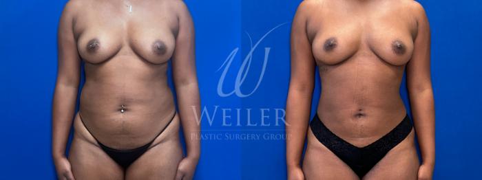 Before & After Liposuction Case 1803 Front View in Baton Rouge, New Orleans, & Lafayette, Louisiana
