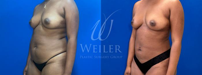 Before & After Liposuction Case 1803 Left Oblique View in Baton Rouge, New Orleans, & Lafayette, Louisiana