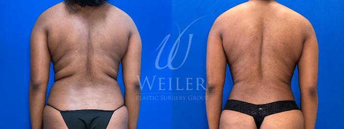 Before & After Liposuction Case 1803 Left Side View in Baton Rouge, New Orleans, & Lafayette, Louisiana