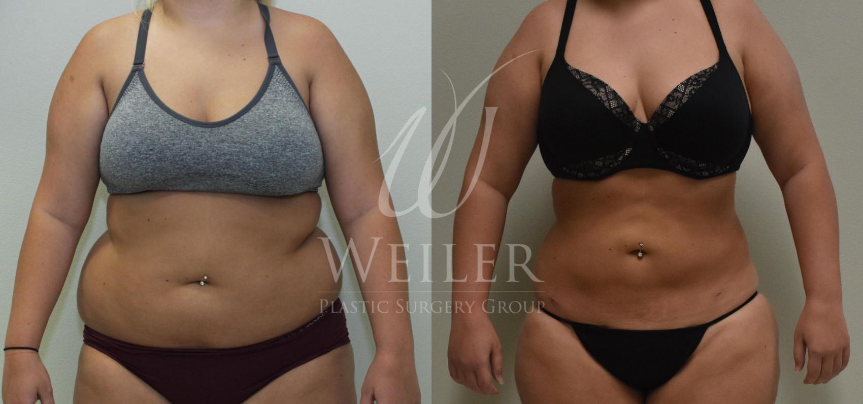 Before & After Liposuction Case 227 View #1 View in Baton Rouge, New Orleans, & Lafayette, Louisiana
