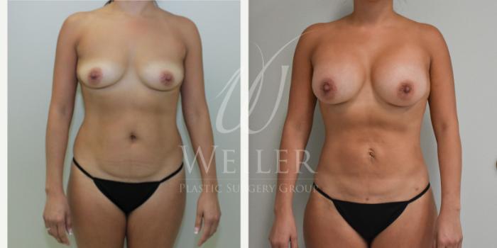 Before & After Liposuction Case 256 View #1 View in Baton Rouge, New Orleans, & Lafayette, Louisiana