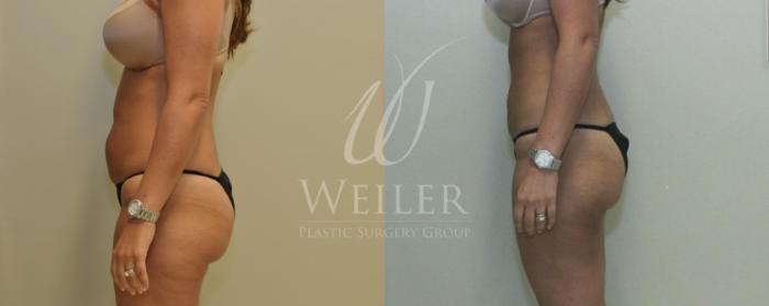 Before & After Liposuction Case 274 View #1 View in Baton Rouge, New Orleans, & Lafayette, Louisiana