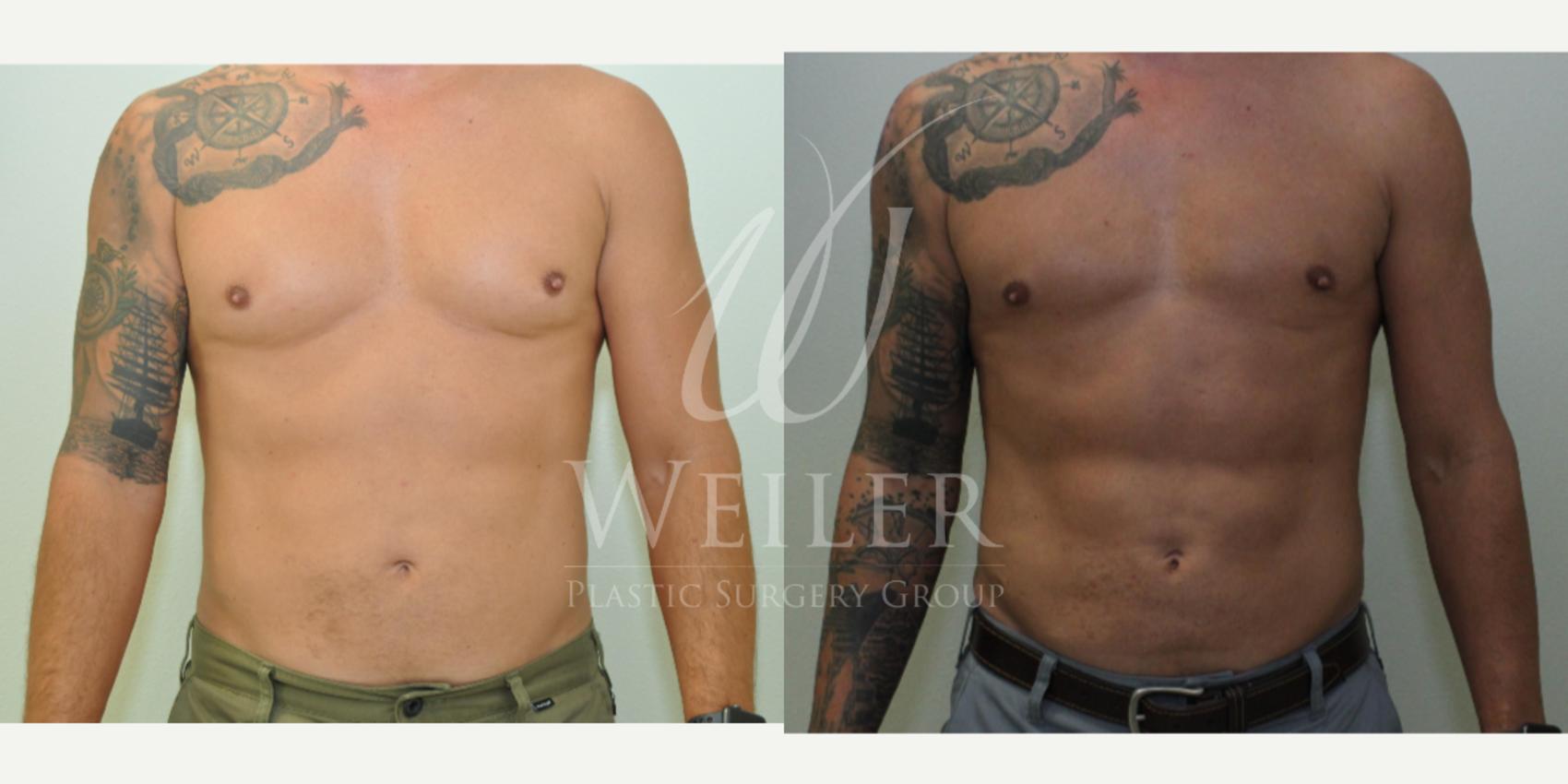 Before & After Liposuction Case 283 View #1 View in Baton Rouge, Louisiana