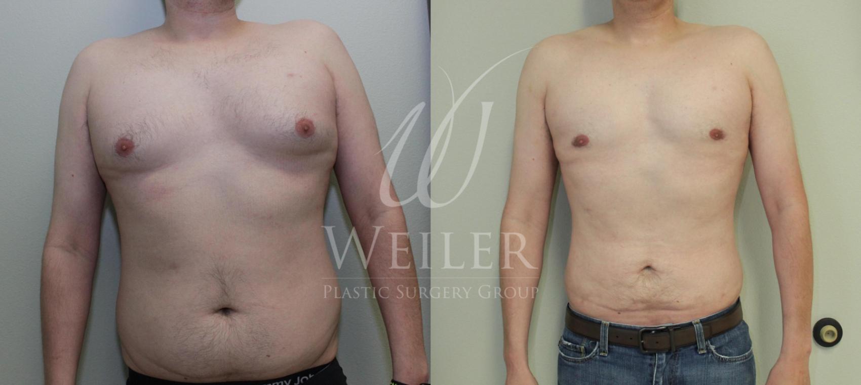 Before & After Liposuction Case 445 View #1 View in Baton Rouge, Louisiana