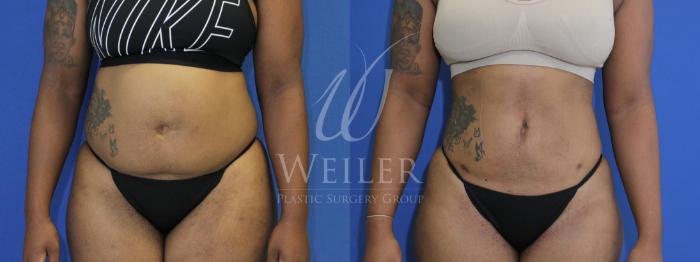 Before & After Liposuction Case 487 Front View in Baton Rouge, New Orleans, & Lafayette, Louisiana