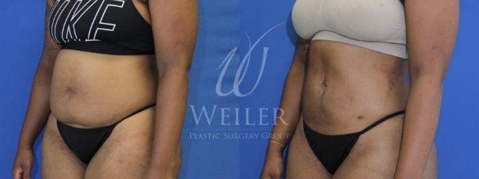 Before & After Liposuction Case 487 Left Oblique View in Baton Rouge, New Orleans, & Lafayette, Louisiana