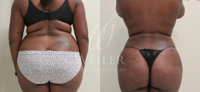 Before & After Liposuction Case 54 View #1 View in Baton Rouge, New Orleans, & Lafayette, Louisiana