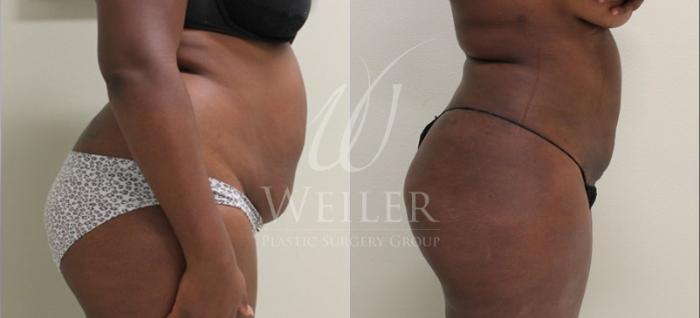 Before & After Liposuction Case 54 View #2 View in Baton Rouge, New Orleans, & Lafayette, Louisiana