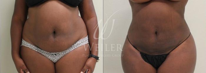 Before & After Liposuction Case 54 View #3 View in Baton Rouge, New Orleans, & Lafayette, Louisiana
