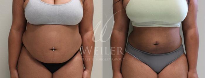 Before & After Liposuction Case 55 View #1 View in Baton Rouge, New Orleans, & Lafayette, Louisiana