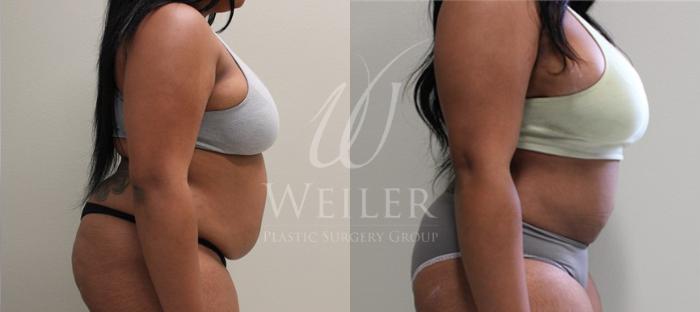 Before & After Liposuction Case 55 View #2 View in Baton Rouge, New Orleans, & Lafayette, Louisiana
