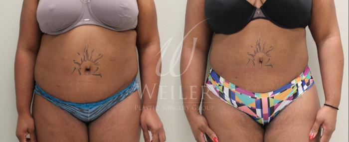 Before & After Liposuction Case 56 View #1 View in Baton Rouge, New Orleans, & Lafayette, Louisiana