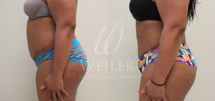 Before & After Liposuction Case 56 View #2 View in Baton Rouge, New Orleans, & Lafayette, Louisiana