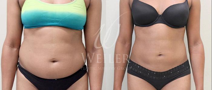 Before & After Liposuction Case 57 View #1 View in Baton Rouge, New Orleans, & Lafayette, Louisiana
