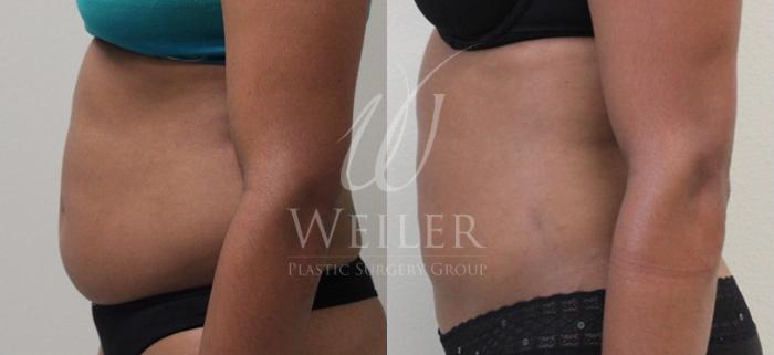 Before & After Liposuction Case 57 View #2 View in Baton Rouge, New Orleans, & Lafayette, Louisiana