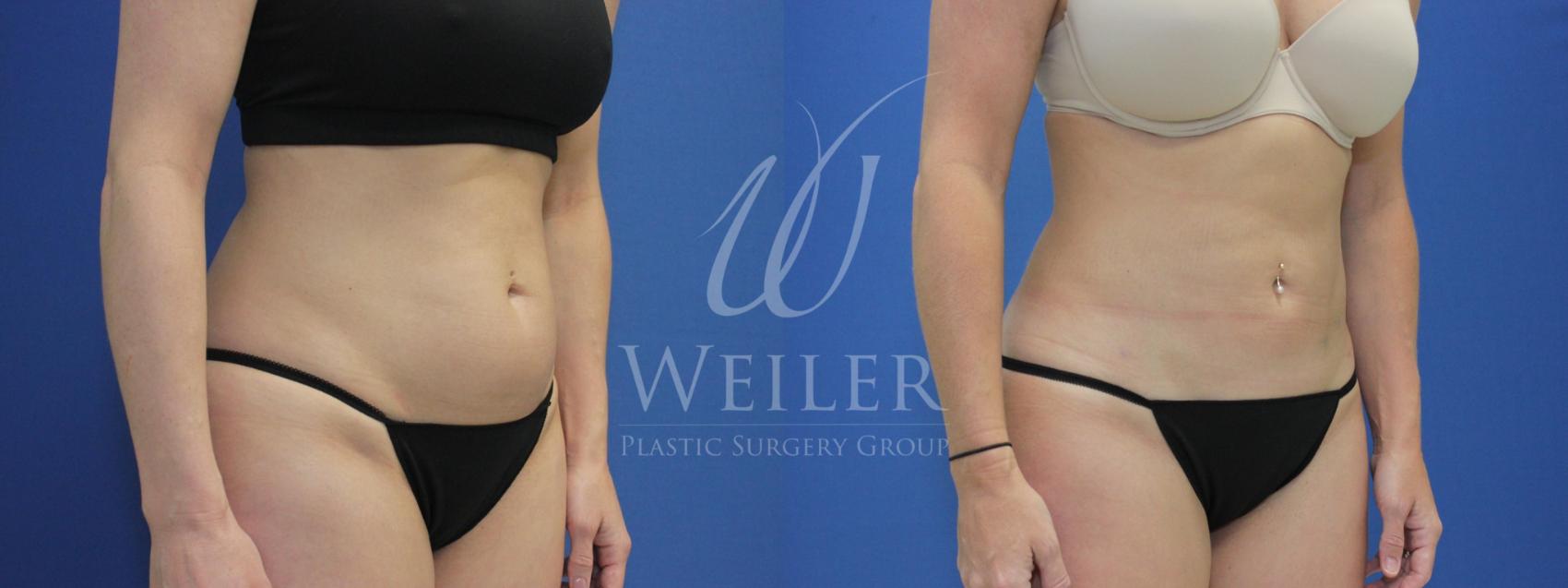 Before & After Liposuction Case 577 Right Oblique View in Baton Rouge, Louisiana