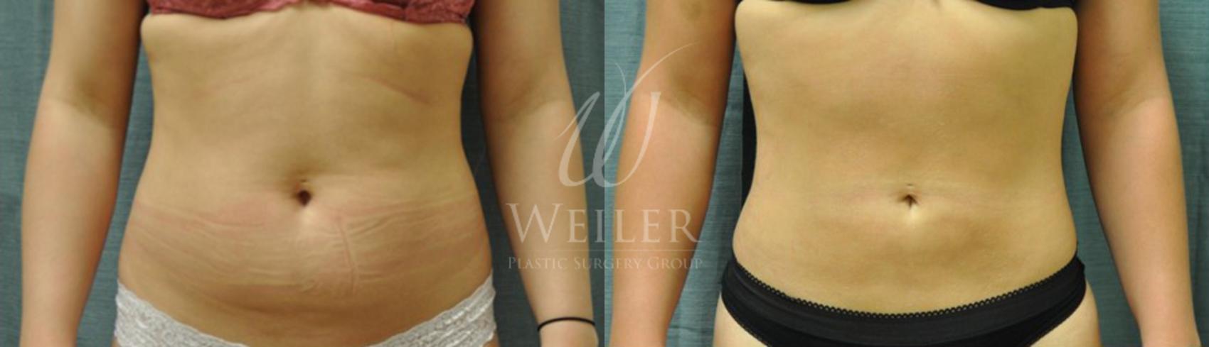 Before & After Liposuction Case 58 View #1 View in Baton Rouge, New Orleans, & Lafayette, Louisiana