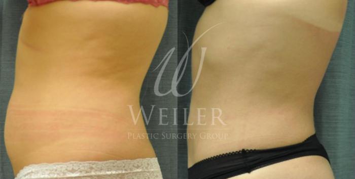Before & After Liposuction Case 58 View #2 View in Baton Rouge, New Orleans, & Lafayette, Louisiana
