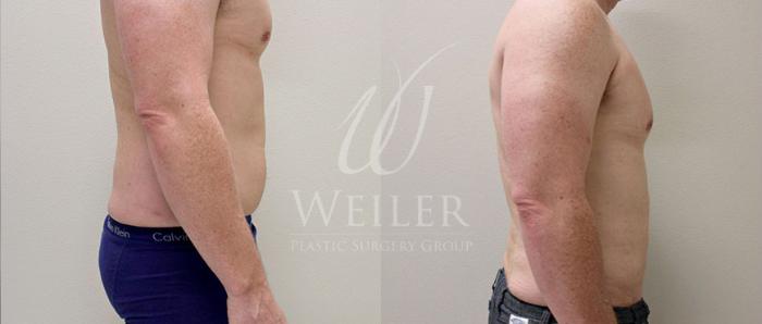 Before & After Liposuction Case 59 View #1 View in Baton Rouge, New Orleans, & Lafayette, Louisiana