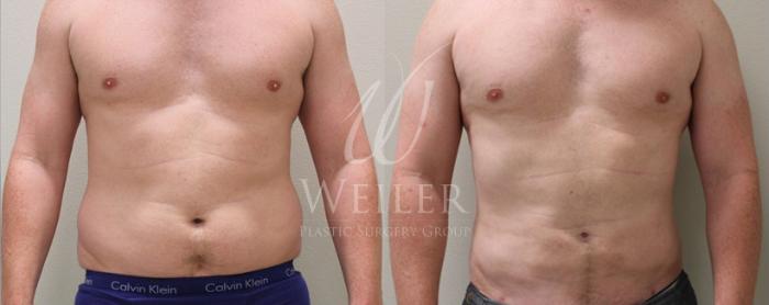 Before & After Liposuction Case 59 View #2 View in Baton Rouge, New Orleans, & Lafayette, Louisiana