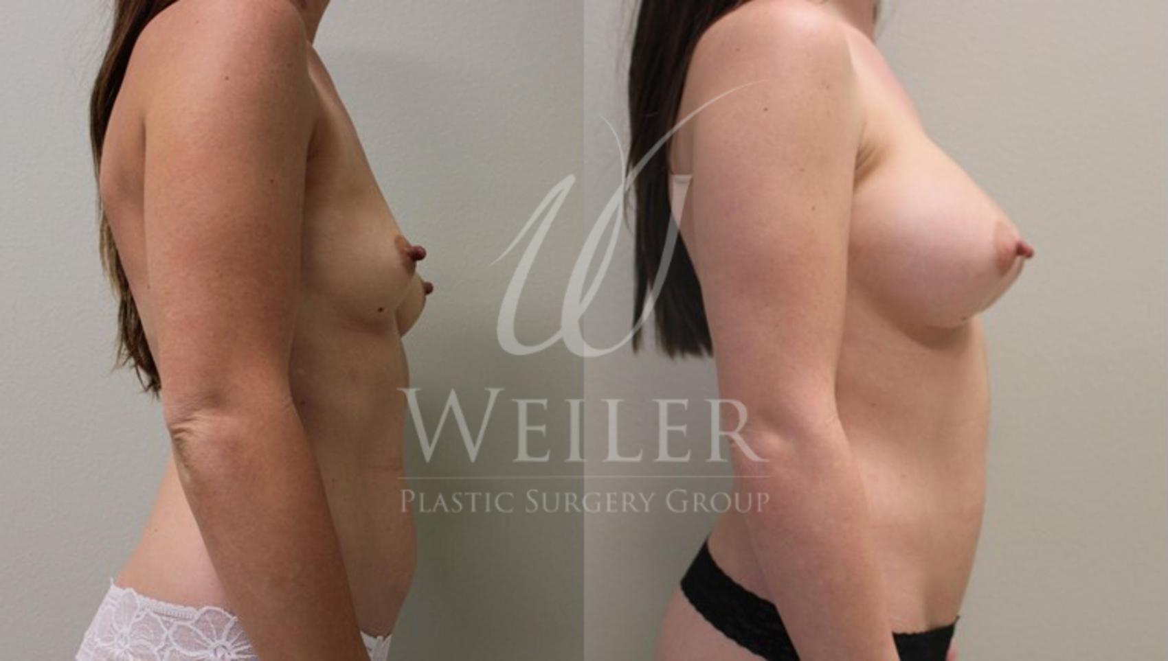 Before & After Liposuction Case 60 View #1 View in Baton Rouge, Louisiana