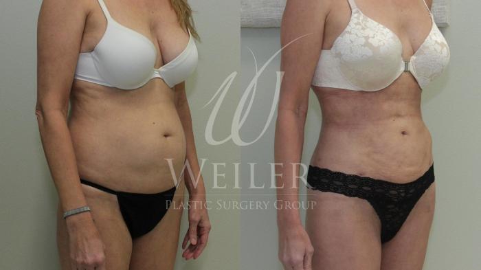 Before & After Liposuction Case 619 Right Oblique View in Baton Rouge, New Orleans, & Lafayette, Louisiana