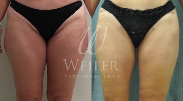 Before & After Liposuction Case 62 View #1 View in Baton Rouge, New Orleans, & Lafayette, Louisiana