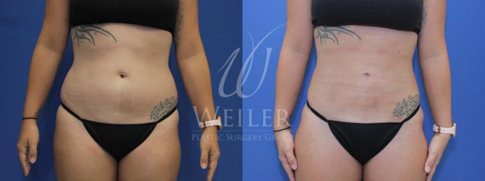Before & After Liposuction Case 643 Front View in Baton Rouge, Louisiana