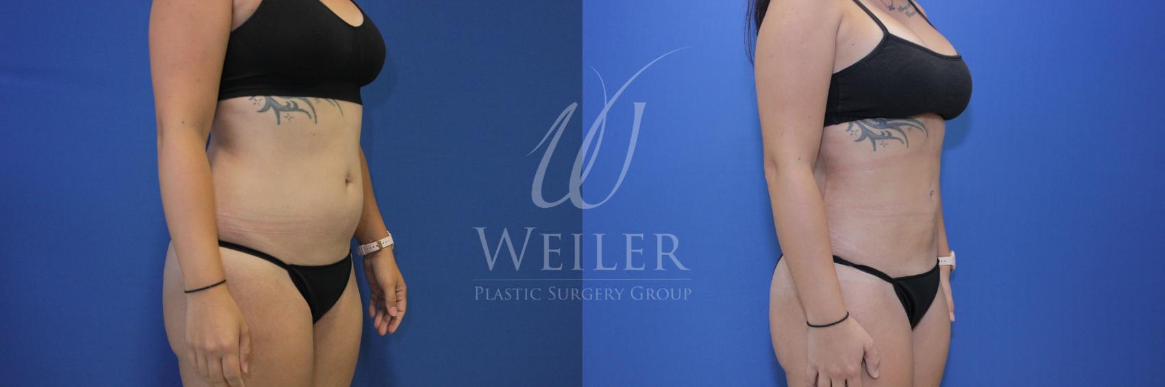 Before & After Liposuction Case 643 Right Oblique View in Baton Rouge, Louisiana