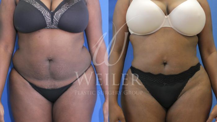 Before & After Liposuction Case 655 Front View in Baton Rouge, New Orleans, & Lafayette, Louisiana