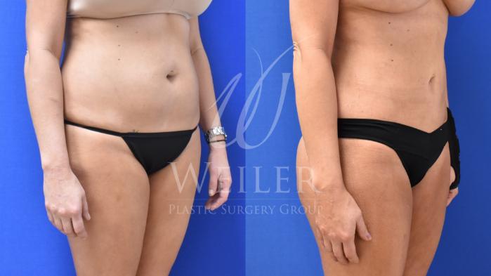 Before & After Liposuction Case 684 Right Oblique View in Baton Rouge, New Orleans, & Lafayette, Louisiana