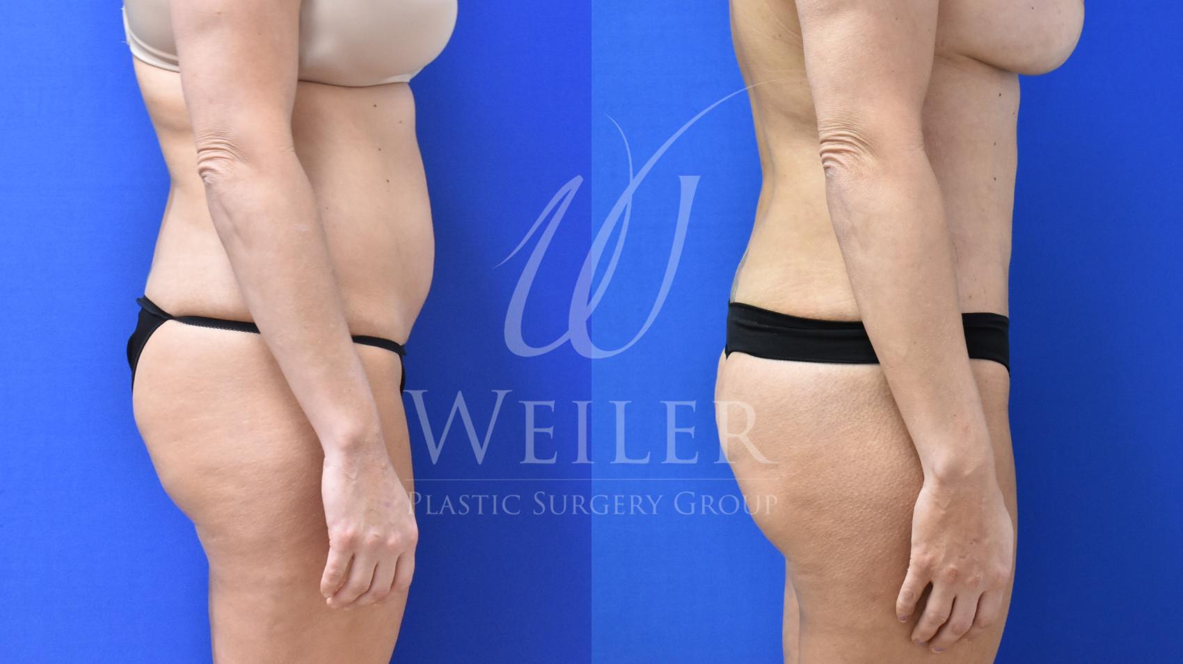 Before & After Liposuction Case 684 Right Side View in Baton Rouge, Louisiana
