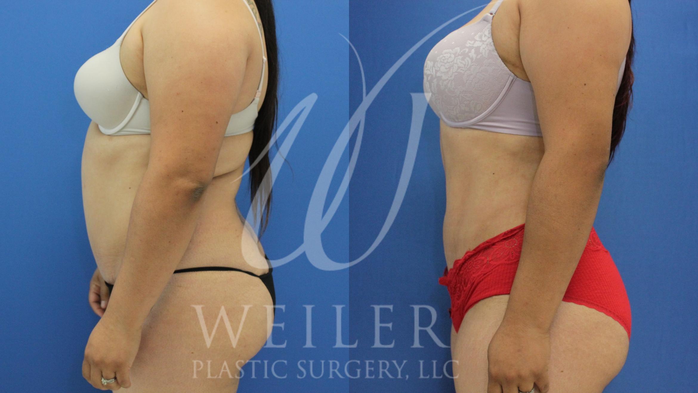 Before & After Liposuction Case 739 Left Side View in Baton Rouge, Louisiana