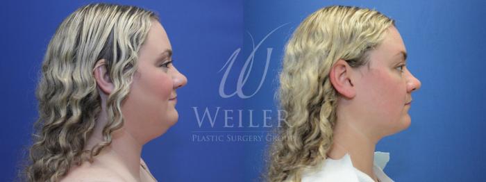 Before & After Liposuction Case 751 Right Side View in Baton Rouge, New Orleans, & Lafayette, Louisiana