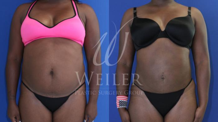 Before & After Liposuction Case 785 Front View in Baton Rouge, Louisiana