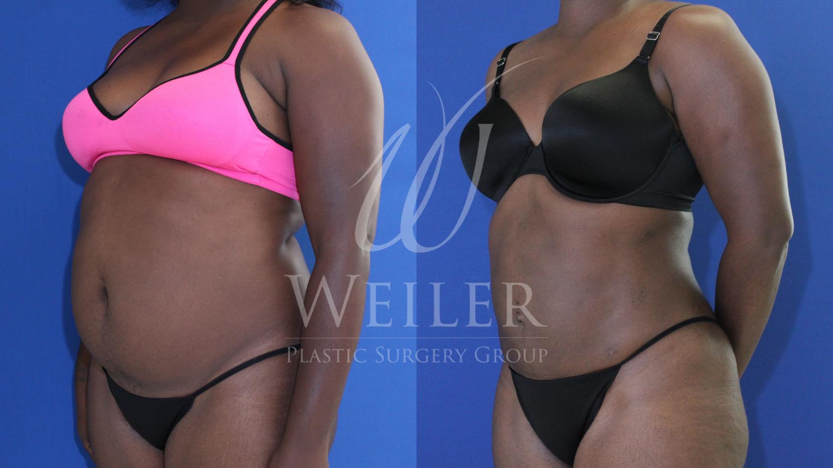 Before & After Liposuction Case 785 Left Oblique View in Baton Rouge, Louisiana