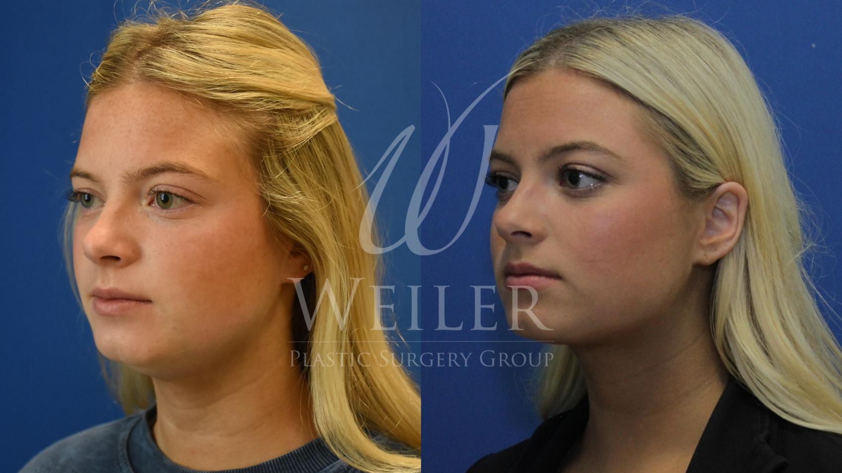 Before & After Liposuction Case 800 Left Oblique View in Baton Rouge, Louisiana