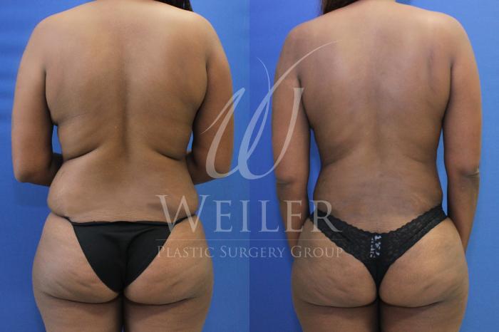 Before & After Liposuction Case 837 Back View in Baton Rouge, New Orleans, & Lafayette, Louisiana