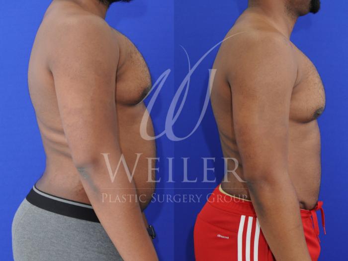 Before & After Liposuction Case 857 Right Side View in Baton Rouge, Louisiana